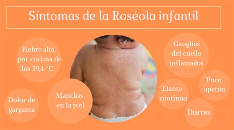 roseola sintomas
